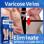 Ointment for Varicose Veins Eliminate Vasculitis Phlebitis to Relieve Spider Leg Pain Treatment Herbal cream - Image 6
