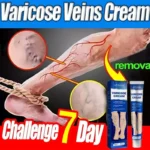 Ointment for Varicose Veins Eliminate Vasculitis Phlebitis to Relieve Spider Leg Pain Treatment Herbal cream - Image 4