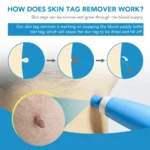 2 IN 1 Auto Micro Skin Tag Remover Device Standard And Micro Skin Tag Removal Kit Adult Mole Wart Remover Face Care Beauty Tools - Image 2