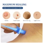 2 In 1 Auto Skin Tag Removal Kit Painless Mole Wart Remover Equipment Micro 1-9mm Treatment Tool Easy To Clean Skin Care Tool - Image 2